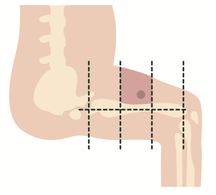 inyección intramuscular en vasto lateral externo